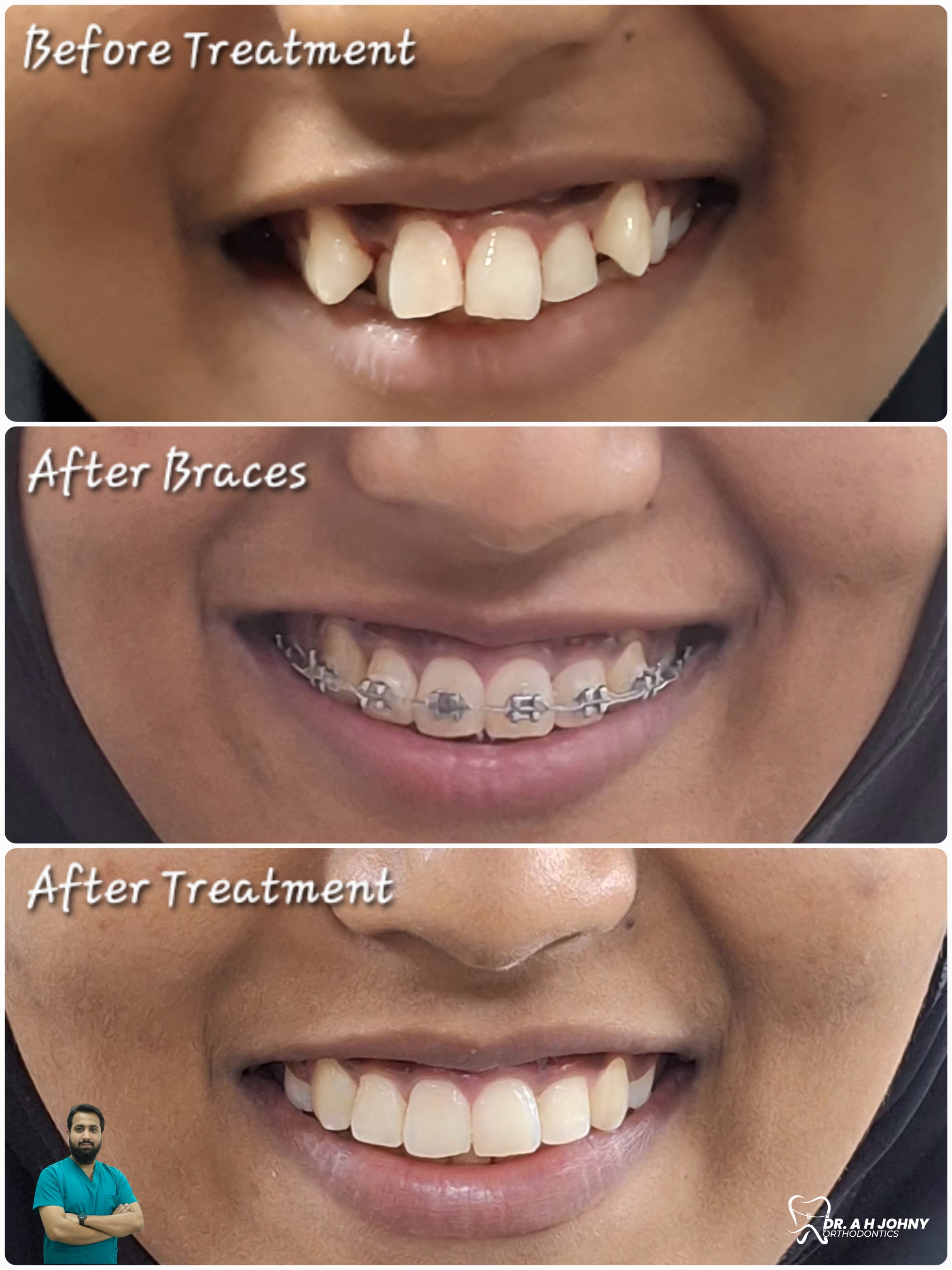 দাঁত বাঁকা হলে কি করা উচিত? (Complete Orthodontic Guide)