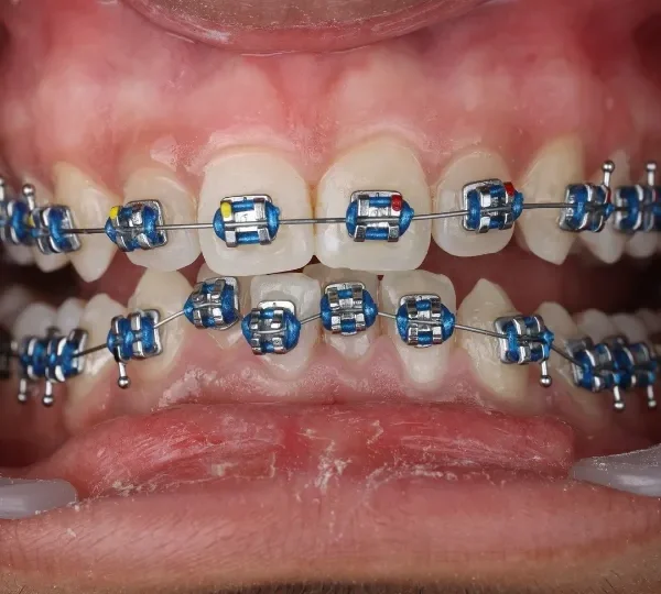 Braces treatment