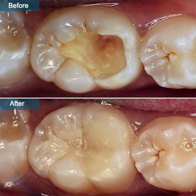 Dental Filling