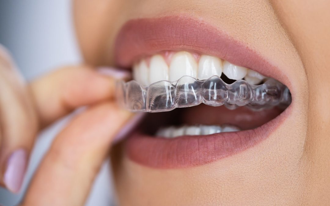 Invisalign Clear Aligner