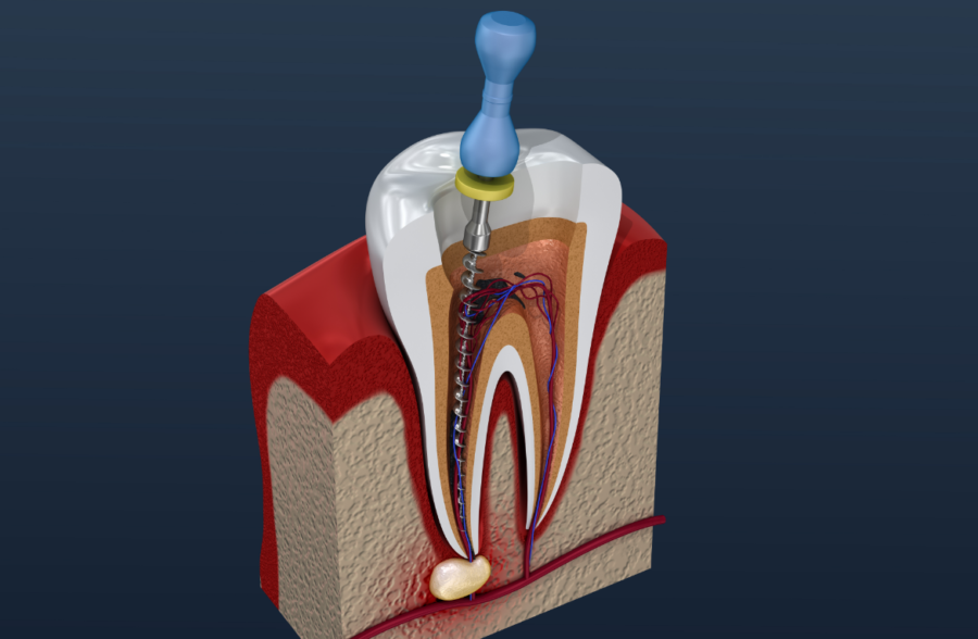 Root Canal Treatment (RCT)