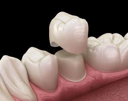 Dental Crown